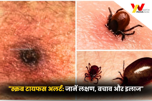 Scrub Typhus से सतर्क रहें: लक्षण, फैलाव और बचाव के उपाय जानें